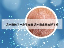 冯小刚长了一身牛皮癣 冯小刚皮肤治好了吗