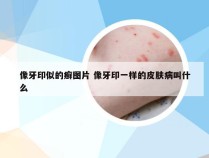 像牙印似的癣图片 像牙印一样的皮肤病叫什么