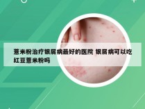 薏米粉治疗银屑病最好的医院 银屑病可以吃红豆薏米粉吗