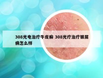 308光电治疗牛皮癣 308光疗治疗银屑病怎么样