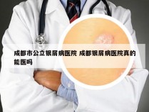 成都市公立银屑病医院 成都银屑病医院真的能医吗