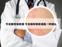牛皮廨和银屑病 牛皮癣和银屑病是一种病么