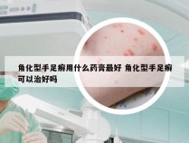 角化型手足癣用什么药膏最好 角化型手足癣可以治好吗