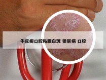 牛皮癣口腔粘膜白斑 银屑病 口腔