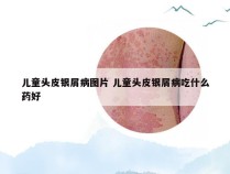 儿童头皮银屑病图片 儿童头皮银屑病吃什么药好