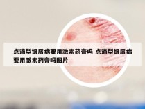 点滴型银屑病要用激素药膏吗 点滴型银屑病要用激素药膏吗图片