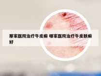 那家医院治疗牛皮癣 哪家医院治疗牛皮肤癣好