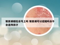 银屑病婚检会写上吗 银屑病可以结婚吗会不会遗传孩子