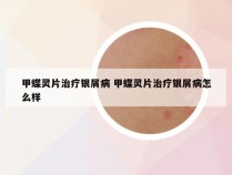 甲蝶灵片治疗银屑病 甲蝶灵片治疗银屑病怎么样