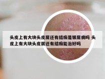 头皮上有大块头皮屑还有结痂是银屑病吗 头皮上有大块头皮屑还有结痂能治好吗