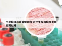 牛皮癣可以输青霉素吗 治疗牛皮肤癣打青霉素可以吗