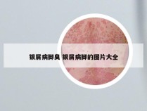 银屑病脚臭 银屑病脚的图片大全