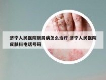 济宁人民医院银屑病怎么治疗 济宁人民医院皮肤科电话号码