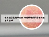 银屑病引起的甲凹点 银屑病导致的指甲凹陷怎么治好