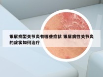 银屑病型关节炎有哪些症状 银屑病性关节炎的症状如何治疗