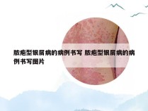 脓疱型银屑病的病例书写 脓疱型银屑病的病例书写图片