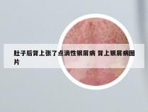 肚子后背上张了点滴性银屑病 背上银屑病图片