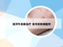 清河牛皮癣治疗 清河皮肤病医院