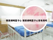 银屑病喝莲子心 银屑病喝莲子心茶有用吗