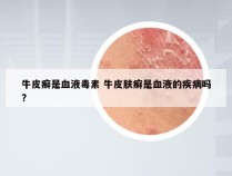 牛皮癣是血液毒素 牛皮肤癣是血液的疾病吗?