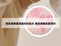 银屑病那看得最好的地方 银屑病哪里看得好