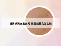 银屑病英文怎么写 银屑病英文怎么说
