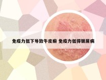 免疫力低下导致牛皮癣 免疫力低得银屑病