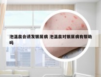 泡温泉会诱发银屑病 泡温泉对银屑病有帮助吗
