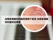 治银屑病最好的医院是哪个省城 治银屑病最好的医院在哪里