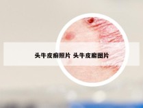 头牛皮癣照片 头牛皮廨图片