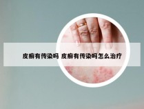 皮癣有传染吗 皮癣有传染吗怎么治疗