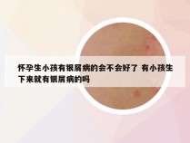 怀孕生小孩有银屑病的会不会好了 有小孩生下来就有银屑病的吗