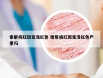 银屑病红斑变浅红色 银屑病红斑变浅红色严重吗