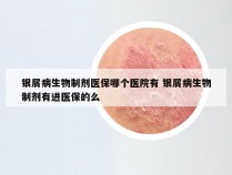 银屑病生物制剂医保哪个医院有 银屑病生物制剂有进医保的么