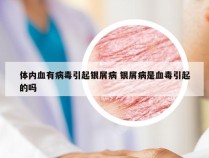 体内血有病毒引起银屑病 银屑病是血毒引起的吗
