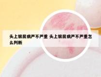 头上银屑病严不严重 头上银屑病严不严重怎么判断