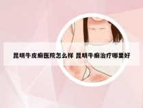 昆明牛皮癣医院怎么样 昆明牛癣治疗哪里好