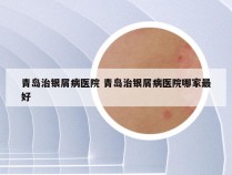青岛治银屑病医院 青岛治银屑病医院哪家最好