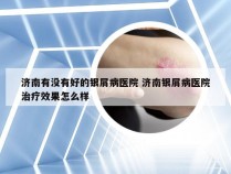 济南有没有好的银屑病医院 济南银屑病医院治疗效果怎么样