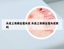 头皮上有癣全是头皮 头皮上有癣全是头皮屑吗