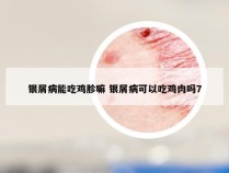 银屑病能吃鸡胗嘛 银屑病可以吃鸡肉吗7