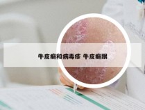 牛皮癣和病毒疹 牛皮癣跟
