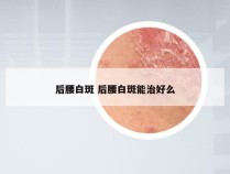 后腰白斑 后腰白斑能治好么