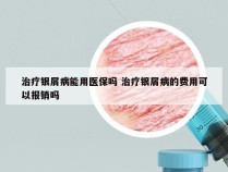 治疗银屑病能用医保吗 治疗银屑病的费用可以报销吗