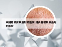 中国看银屑病最好的医院 国内看银屑病最好的医院