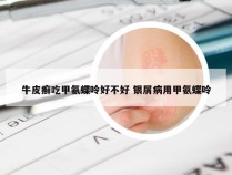 牛皮癣吃甲氨蝶呤好不好 银屑病用甲氨蝶呤