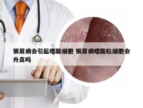 银屑病会引起嗜酸细胞 银屑病嗜酸粒细胞会升高吗