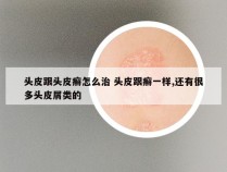 头皮跟头皮癣怎么治 头皮跟癣一样,还有很多头皮屑类的