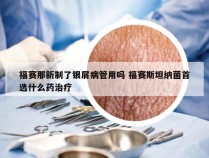福赛那新制了银屑病管用吗 福赛斯坦纳菌首选什么药治疗