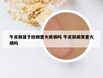 牛皮癣属于隐瞒重大疾病吗 牛皮肤癣算重大病吗